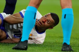 Kylian Mbapp&eacute; fractura nasal