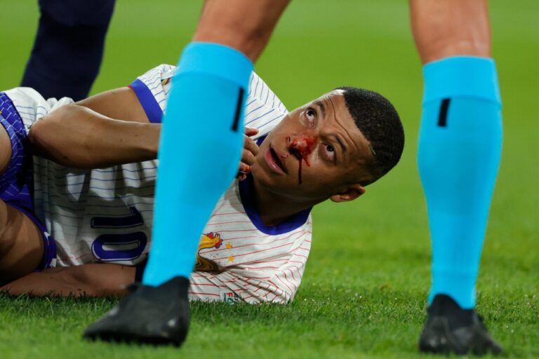 Kylian Mbappé fractura nasal