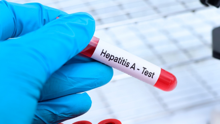 Hepatitis A