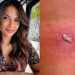 She was bitten by a killer fiddler spider in Ibiza and was saved from amputation: &laquo;I was lucky&raquo;.