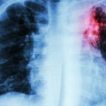 Qué es una fibrosis pulmonar, la enfermedad que padeció Manuel de la Calva