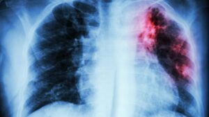 Qu&eacute; es la fibrosis pulmonar