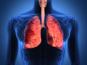 fibrosis pulmonar por que pulmones endurecen 1734026041 1734026106 1735827175 1735827323 1737489409 1737489472 fibrosis pulmonar por que pulmones endurecen 1734026041 1734026106 1735827175 1735827323 1737489409 1737489472