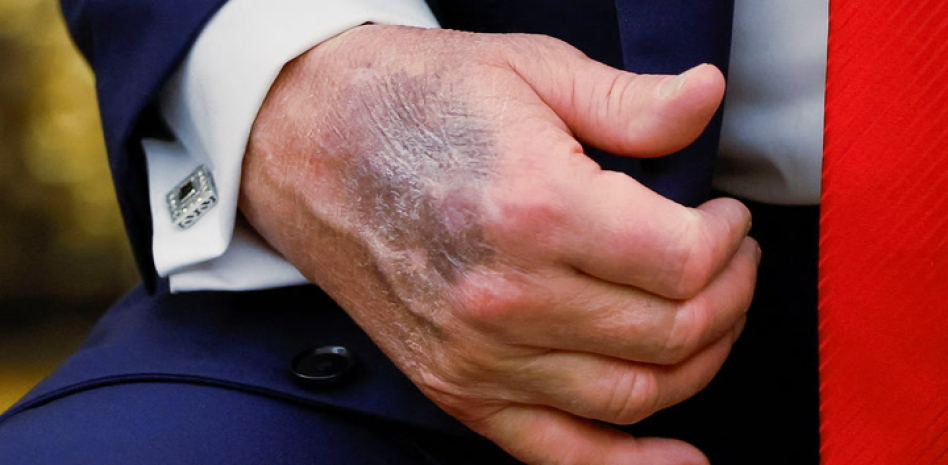 Donald Trump reaparece públicamente y su mancha genera preocupación