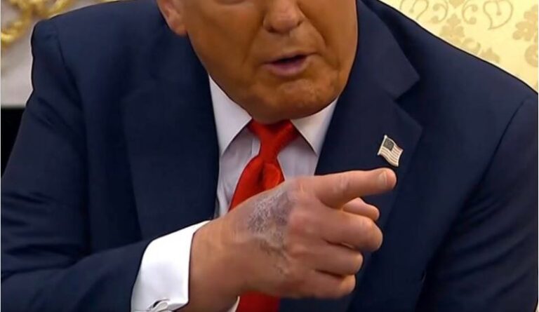 Preocupaci&oacute;n por la creciente mancha de Donald Trump en su mano