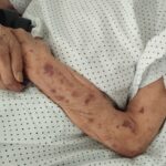 Moretones, sedaci&oacute;n y una &uacute;lcera: as&iacute; denuncian el maltrato a una anciana en Ibiza